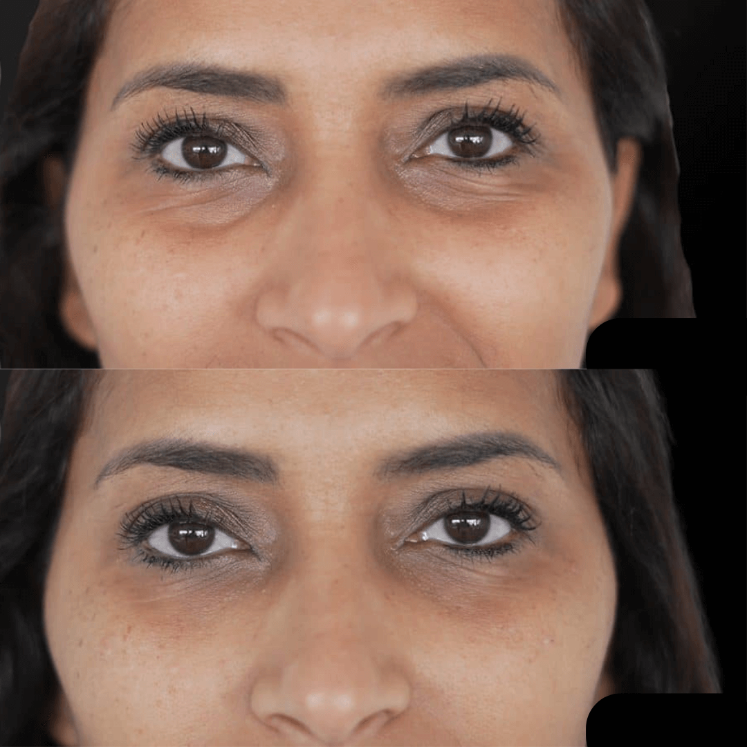 Face Lift Pro™ – Raffermit & rajeunit instantanément