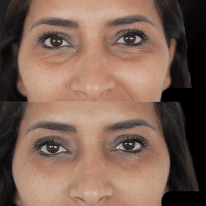 Face Lift Pro™ – Raffermit & rajeunit instantanément
